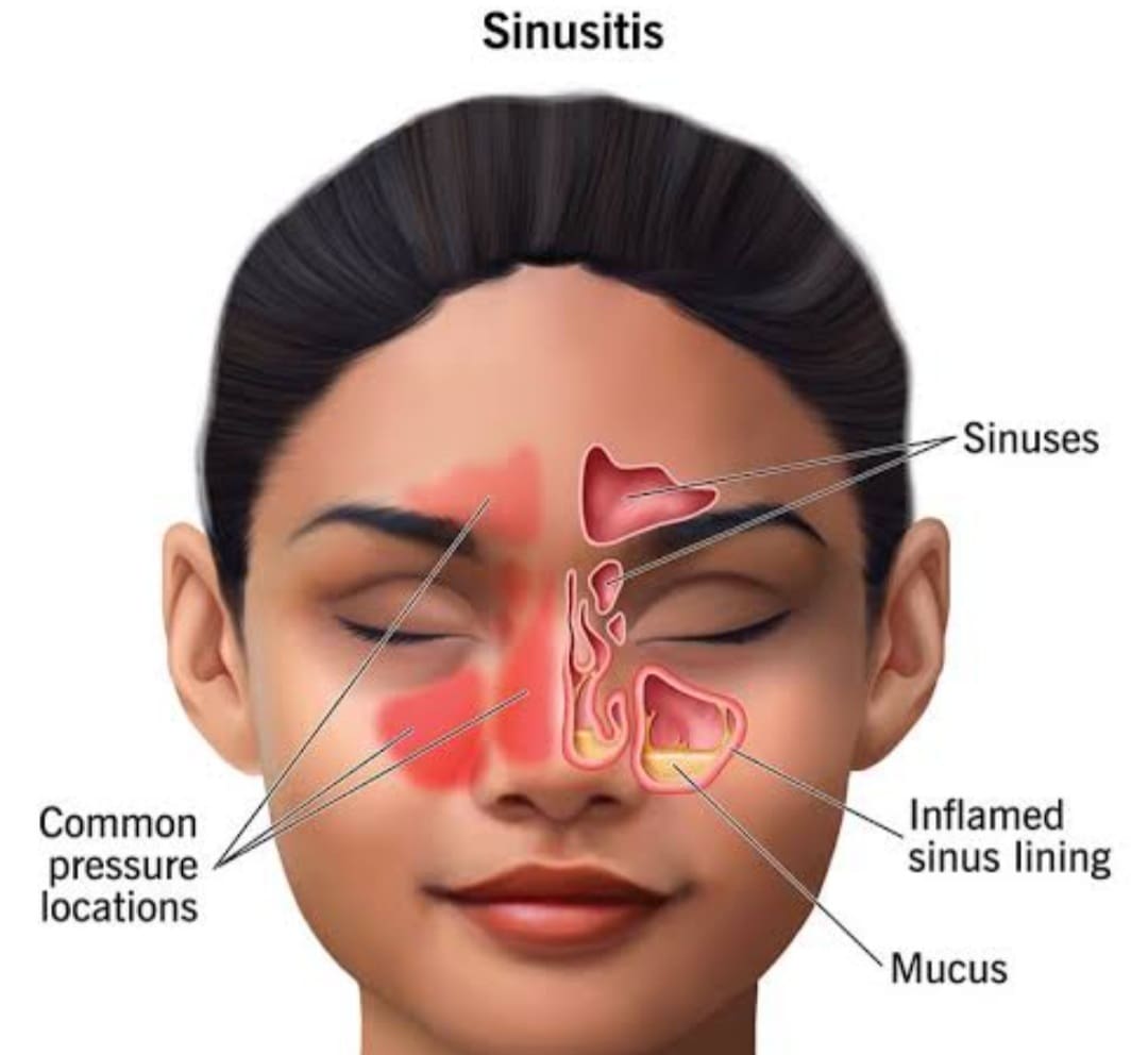 What is a sinus headache?